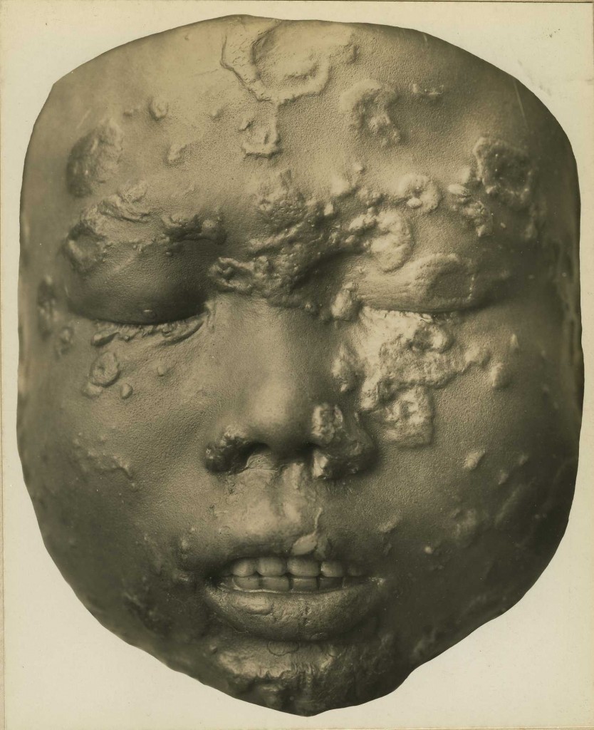Child Suffering from Yaws, Otis Historical Archives of “National Museum of Health & Medicine” (OTIS Archive 1) 