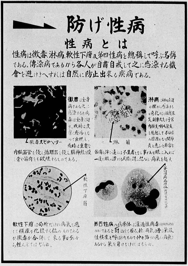 The government identified four sexually-transmitted diseases as the most common forms of VD: syphilis, gonorrhea, chancroid, and lymphogranuloma venereum (LGV). “What Is Venereal Disease?” in Ministry of Health, Department of Disease Prevention, Kokumin yūsei zukai (An Illustrative Guide of National Eugenics) (Tokyo: Kokumin yūsei renmei, 1941).